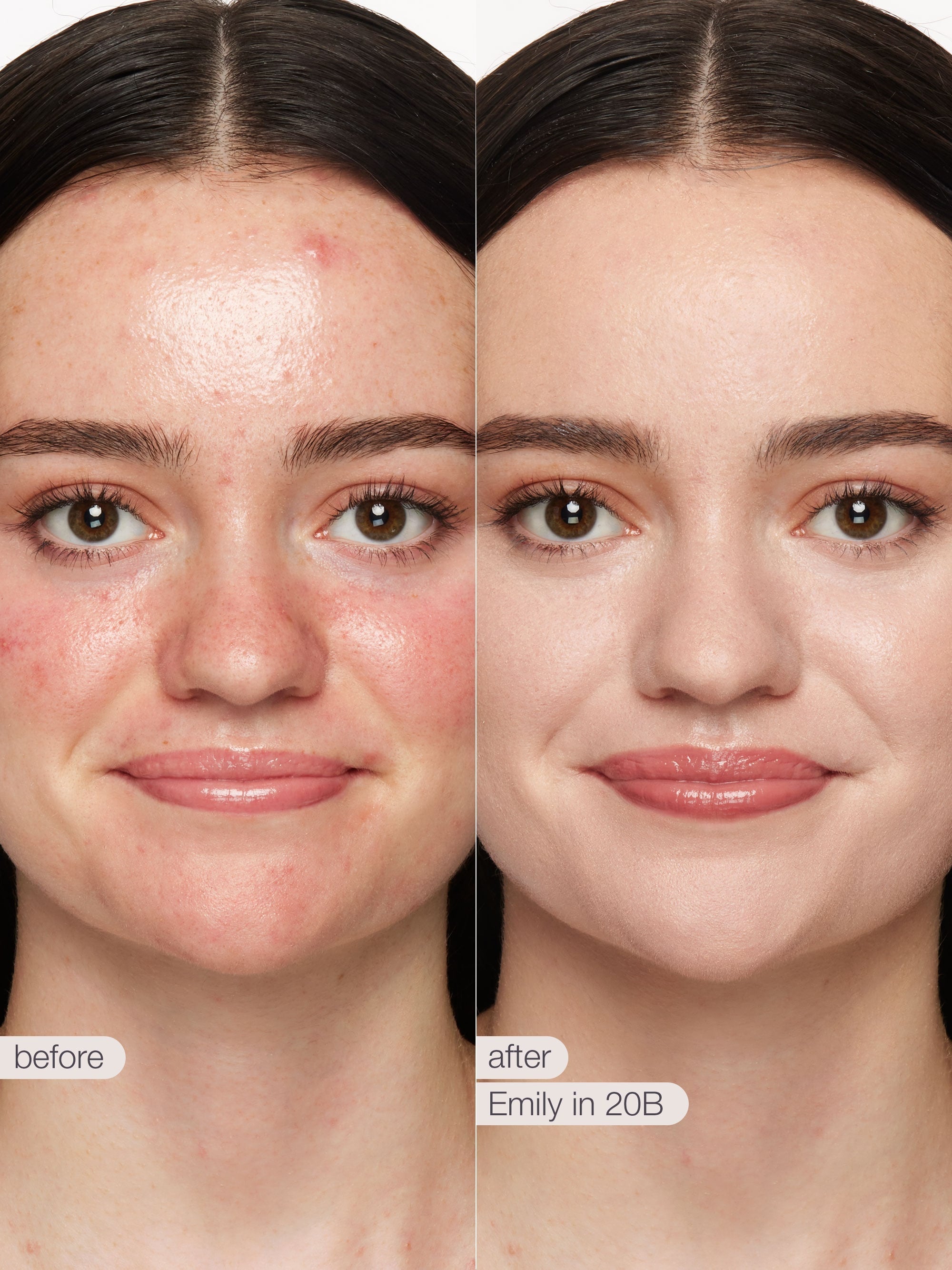Before and after comparison of a woman's face with text 'before' and 'after' and 'Emily in 20B'.
