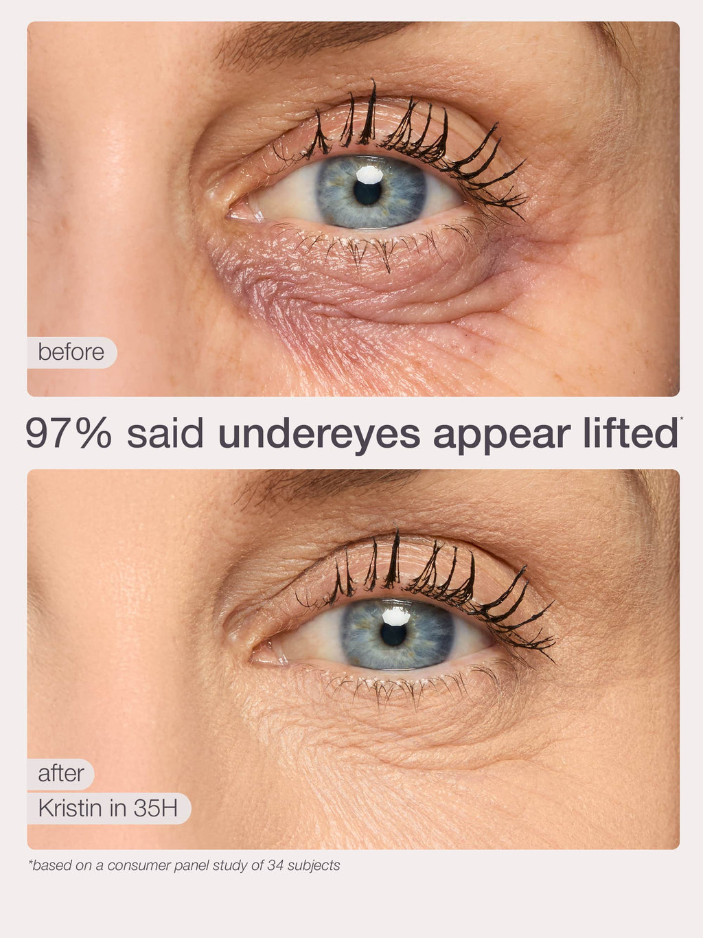 Before and after comparison of under-eye treatment on a person's eye, showing lifted under-eyes.